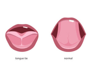 Tongue tie of a baby before and after surgery